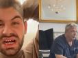 Великий ризик втратити власні зуби набагато раніше: Про що мовчать турецькі стоматологи, які 